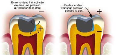 barotraumatisme-dentaire1
